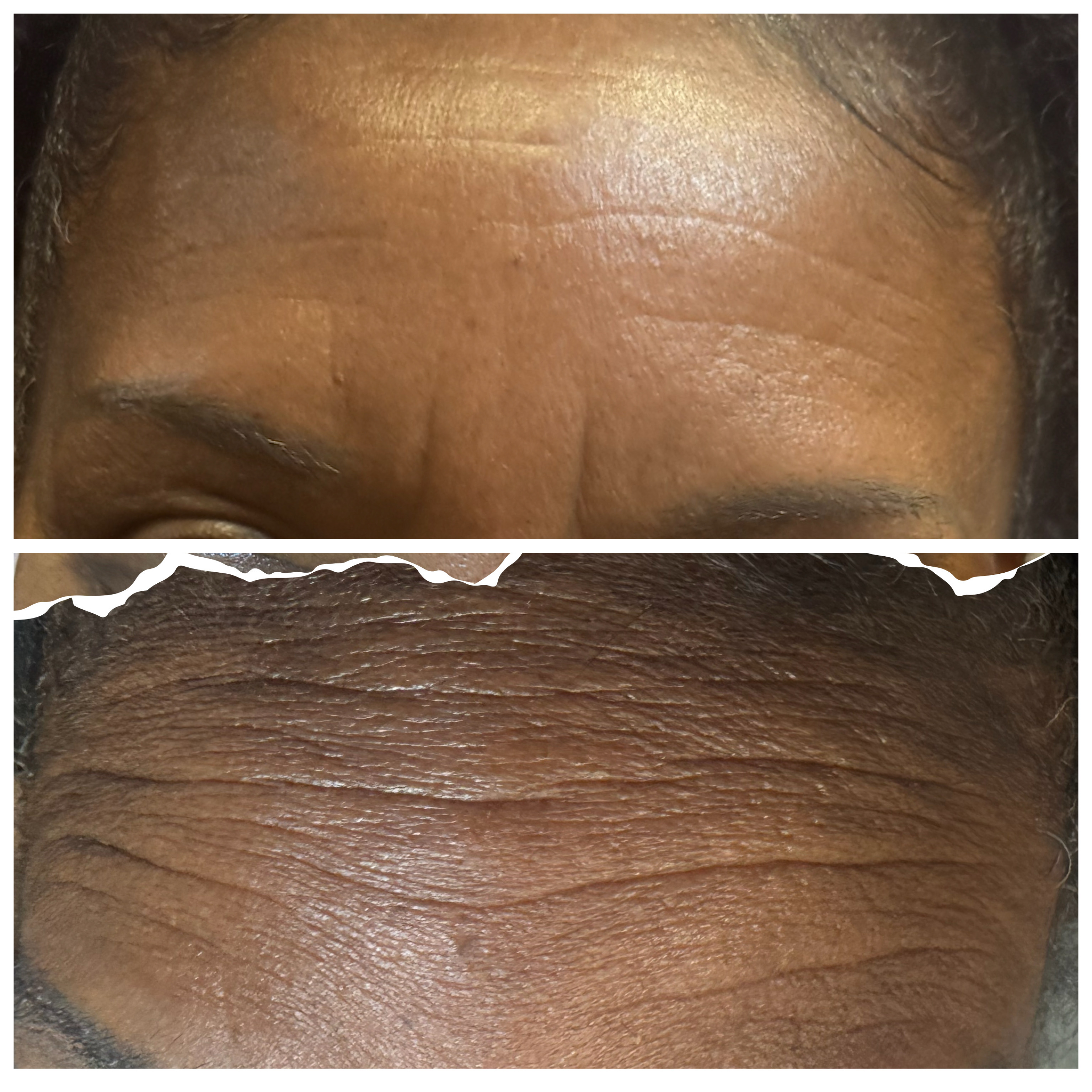 ProCell — Forehead Wrinkle Reduction