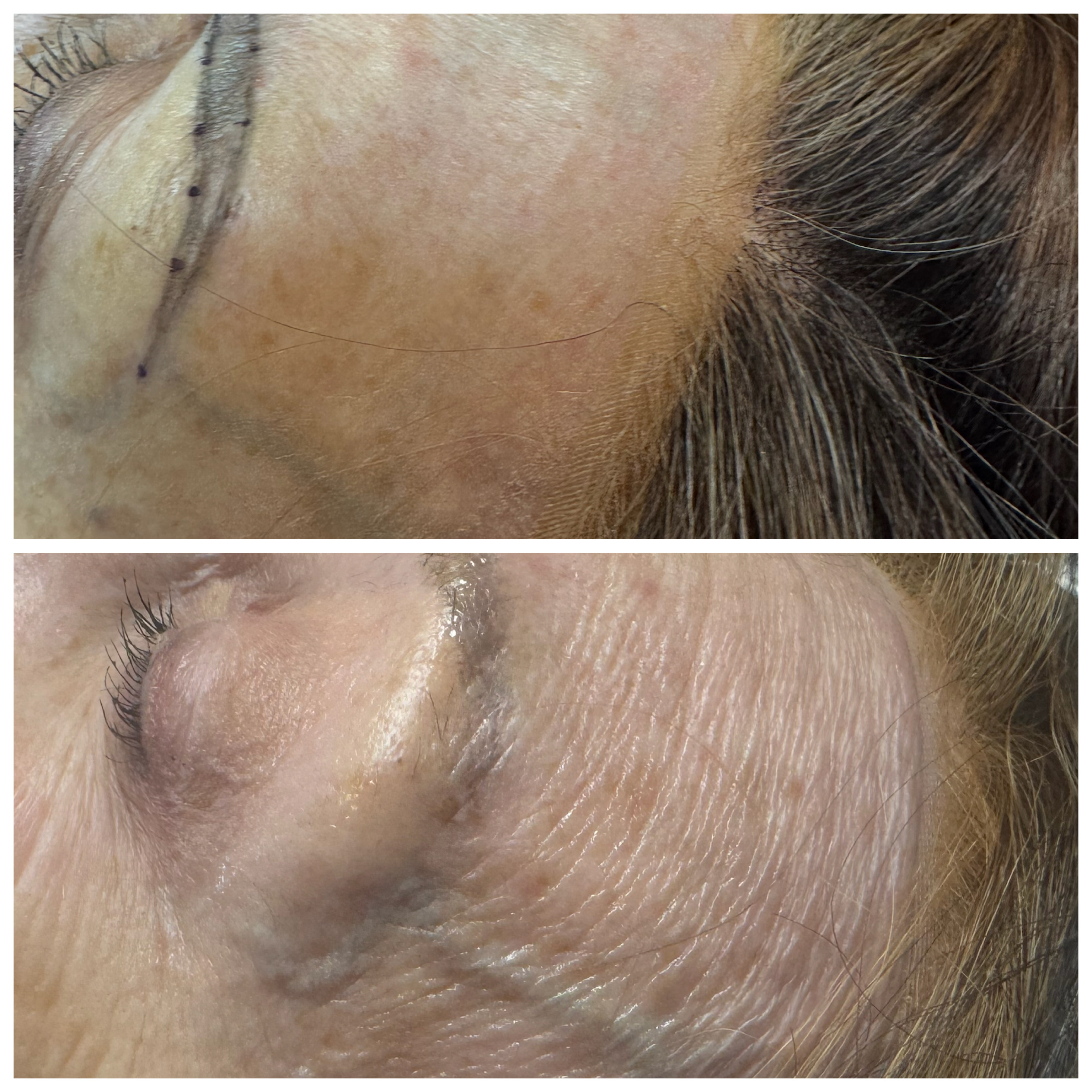 ProCell — Temple & Eye Area