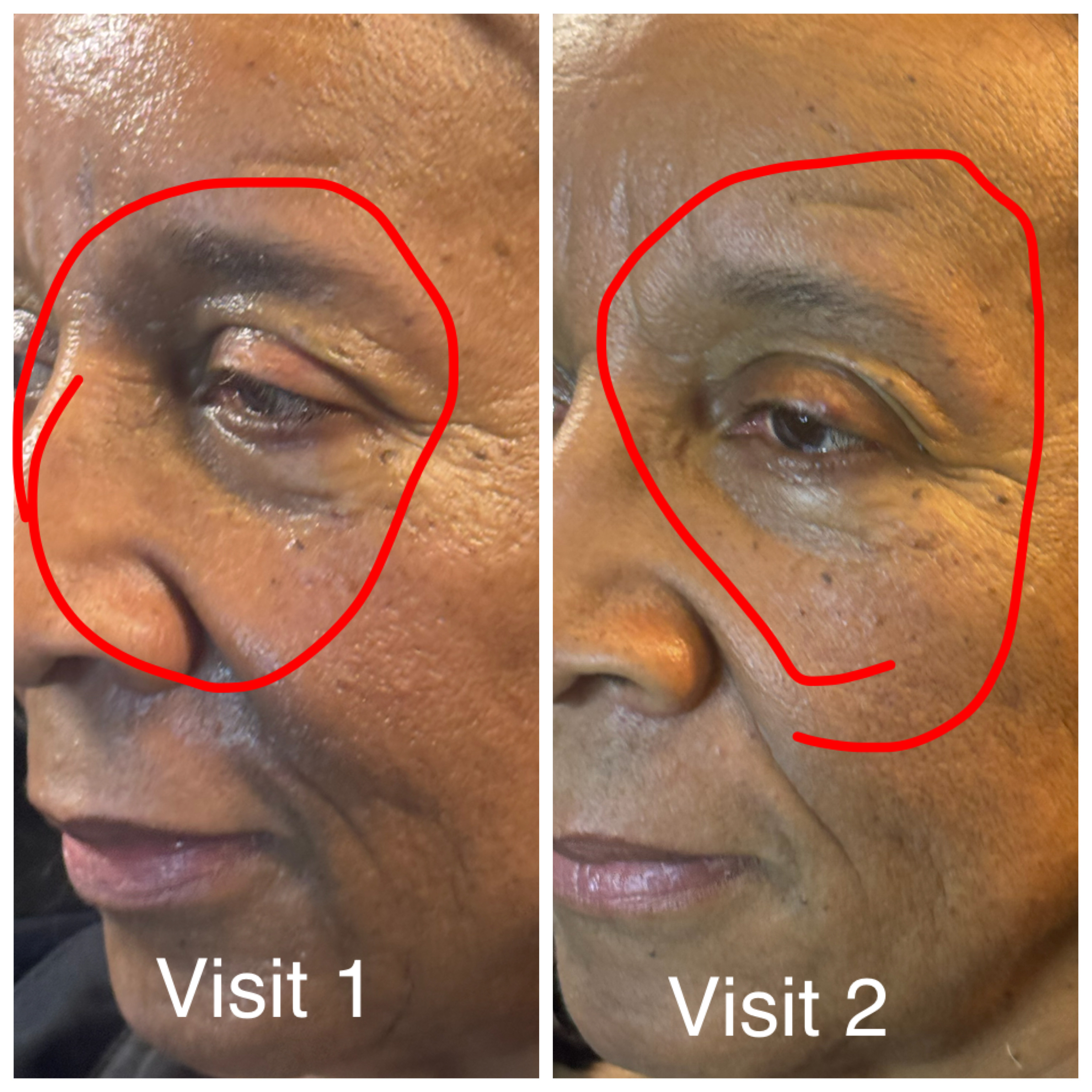 ProCell skin improvement — Visit 1 vs Visit 2